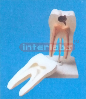 MIDDLE CARIESAND HEALTH MOLAR, (2 purchase)